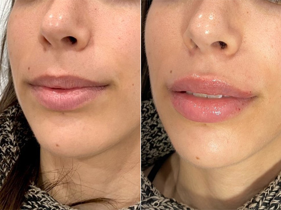 Lip fillers before and after patient