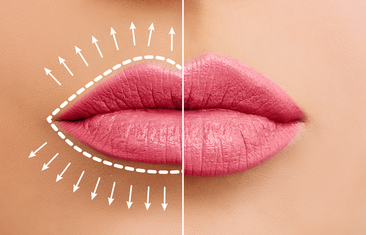 The image shows a split before and after image of lips after undergoing augmentation to represent how you should prepare for a lip filler procedure.