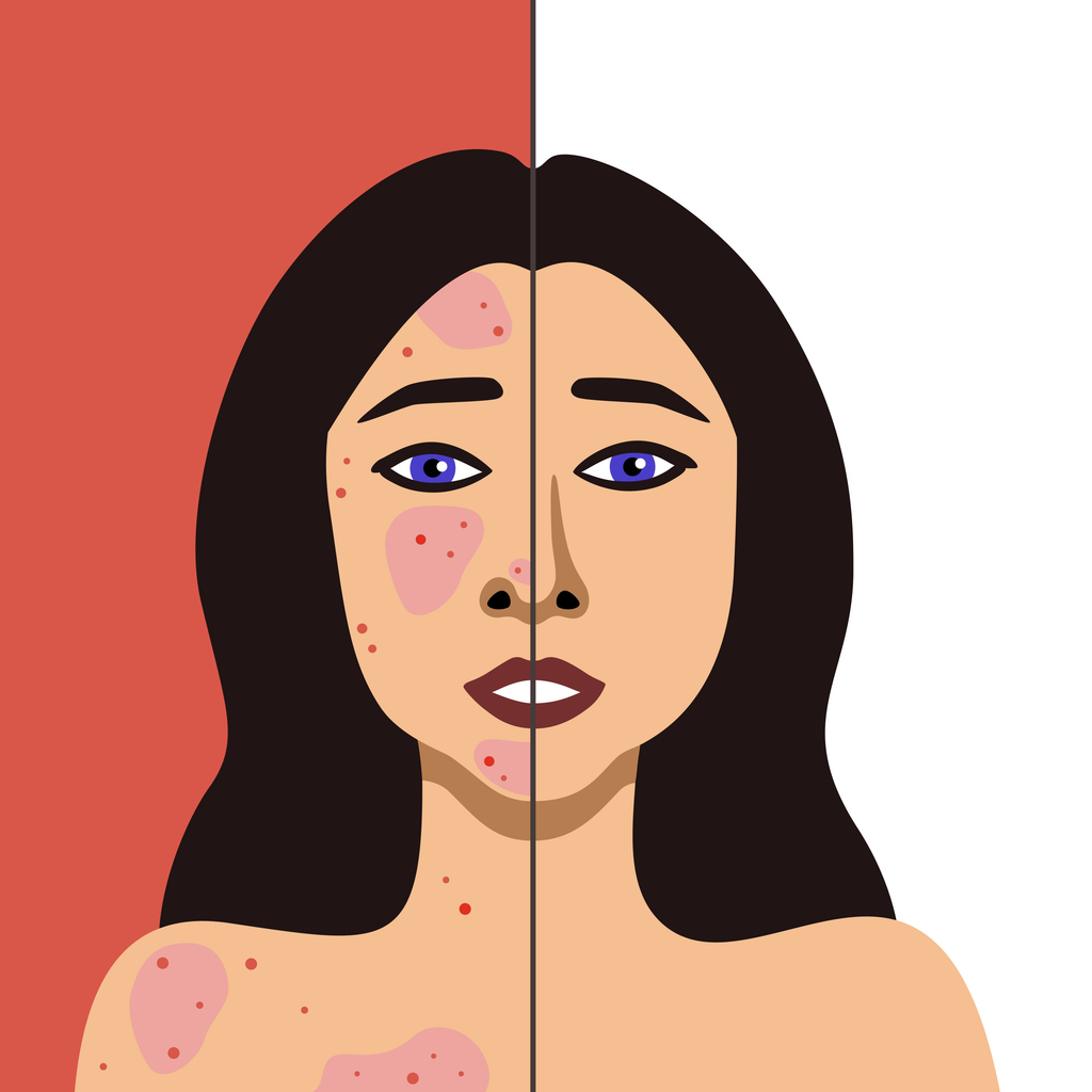 Featured image for why do acne scars develop